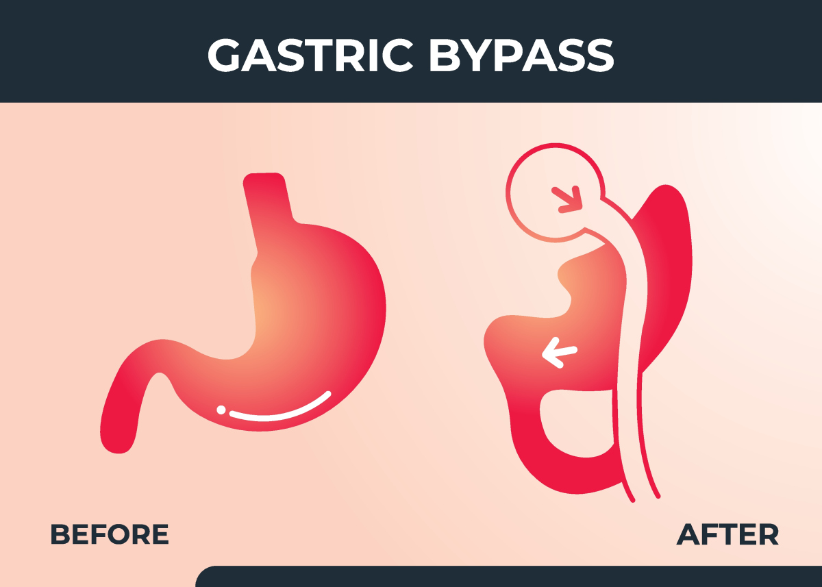 gastric bypass pre op liquid diet,Understanding the Gastric Bypass Pre-Op Liquid Diet