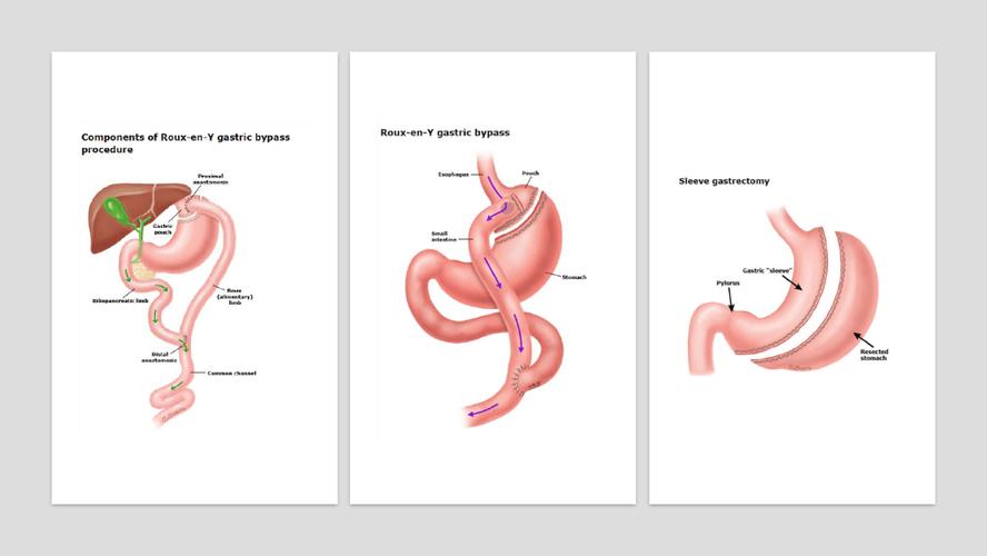 2 week pre op diet gastric sleeve,Understanding the Gastric Sleeve Surgery