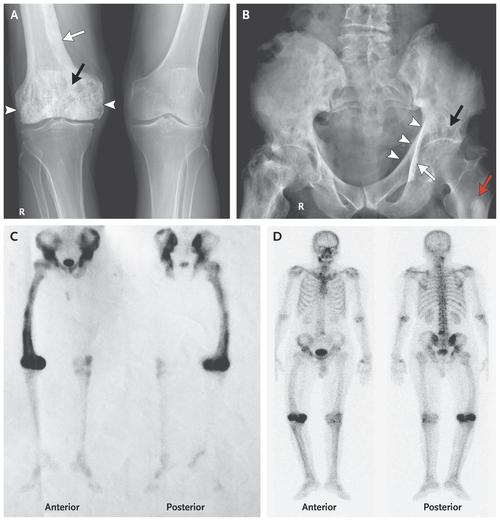 knee replacement post op swelling,Understanding Post-Op Swelling After Knee Replacement