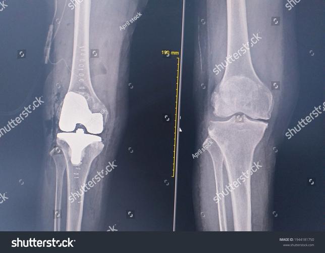 lateral release knee surgery post op,Lateral Release Knee Surgery Post-op: A Comprehensive Guide