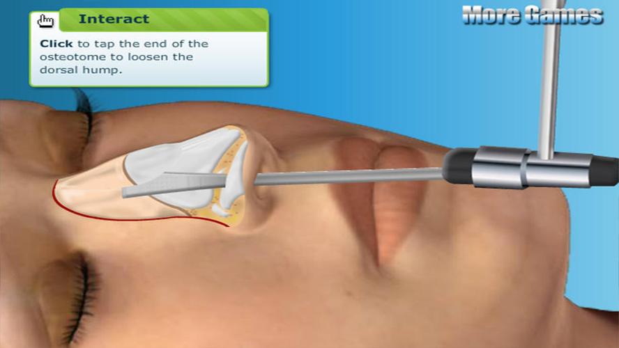 post op nose surgery,Understanding Post-Op Nose Surgery