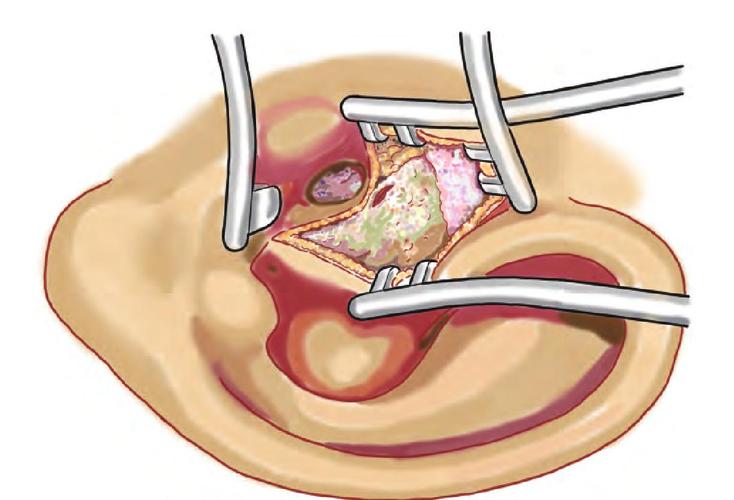 mastoidectomy with tympanoplasty post op,Understanding Mastoidectomy with Tympanoplasty Post-Op