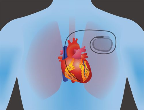 post op pacemaker nursing care,Understanding the Post-Op Pacemaker